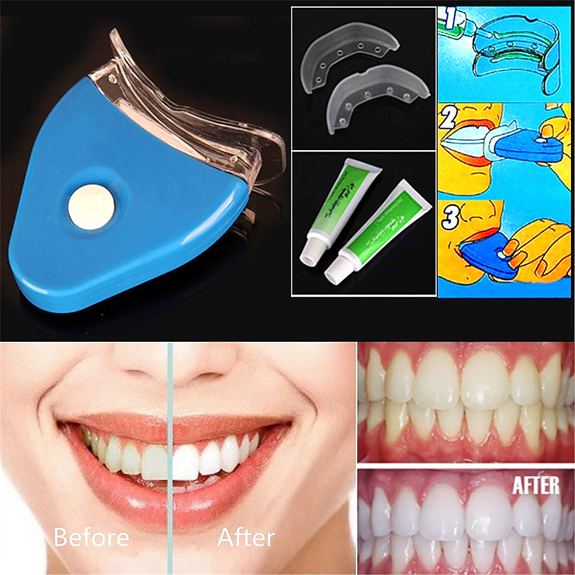 LED Zahnaufhellung Set mit Whitening Gel | Dental Bleaching für Strahlend Weiße Zähne
